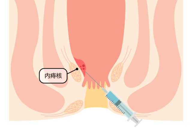 肛門の日帰り手術